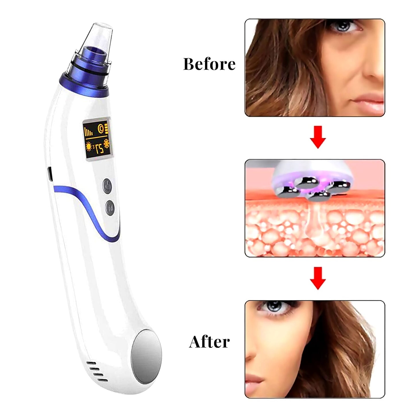 Closeout Aonesy Blackhead Remover - Pink