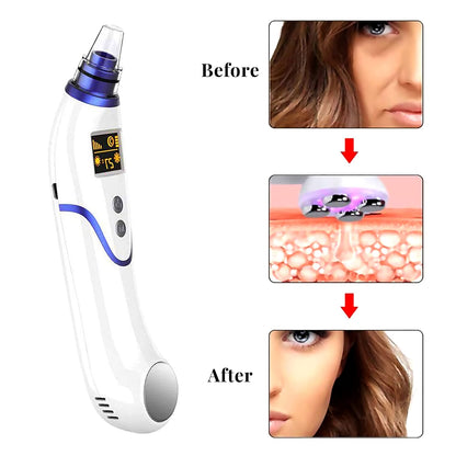 Closeout Aonesy Blackhead Remover - Pink